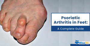 Psoriatic Arthritis